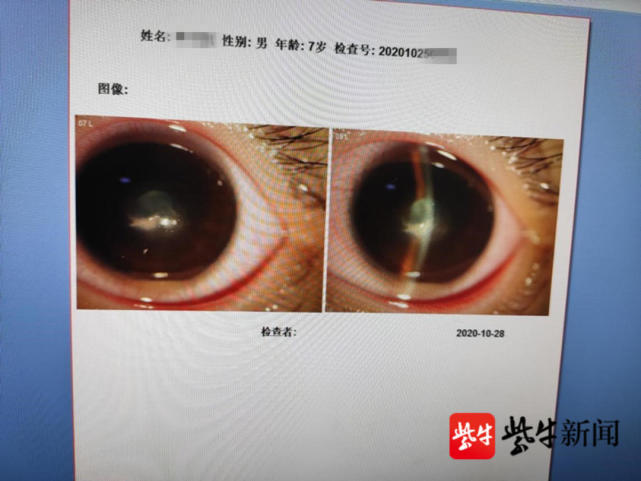 揪心男孩吃烤串被铁签插入眼睛