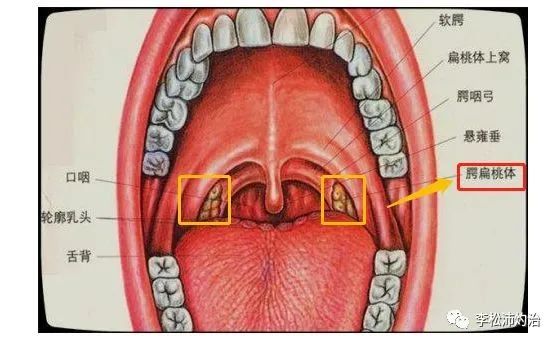 我們經常性說的扁桃體就是顎扁桃體,主要在我們嗓子兩側一側一個,如下