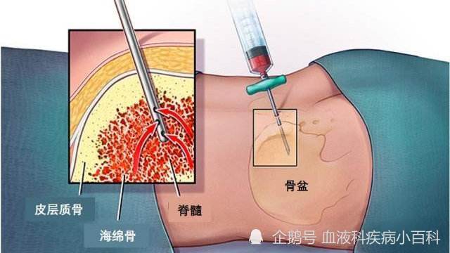 骨髓穿刺到底是什么检查 有没有危害 骨髓 穿刺 血液病