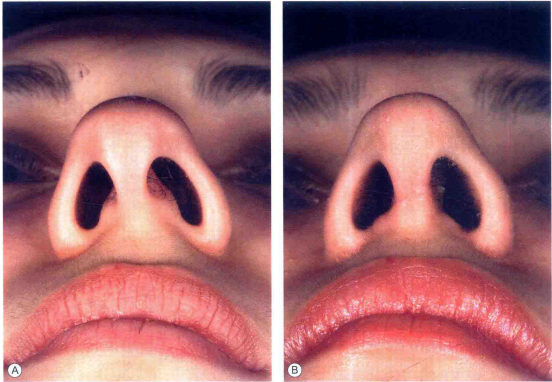 【鼻整形术】调整鼻孔的形状!_腾讯新闻