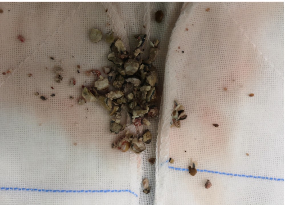 6个月大的孩子,就有输尿管结石?医生:宝宝食物,应该慎重选择