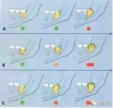 微创拔牙操作过程,超实用拔牙技巧图解!