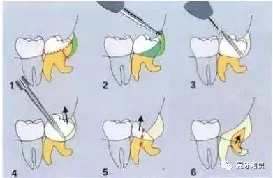 微创拔牙操作过程,超实用拔牙技巧图解!
