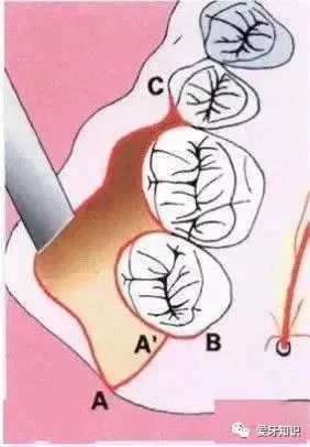 微创拔牙操作过程,超实用拔牙技巧图解!