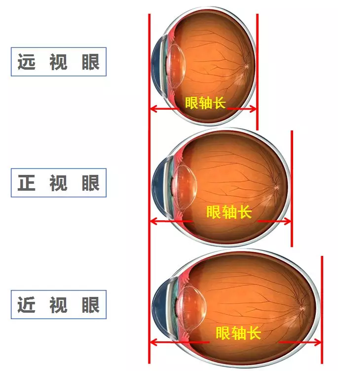 に対応するご意見差別的眼軸近視 Akiha Bunka Jp