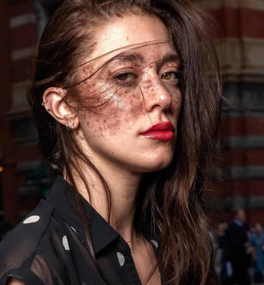 23岁模特脸上长满雀斑,竟是因中风?还成了时尚界新宠?