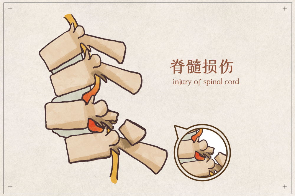 脊髓损伤的紧急处理办法与康复方法