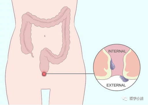 自己治疗痔疮的办法有哪些 划重点啦 腾讯新闻