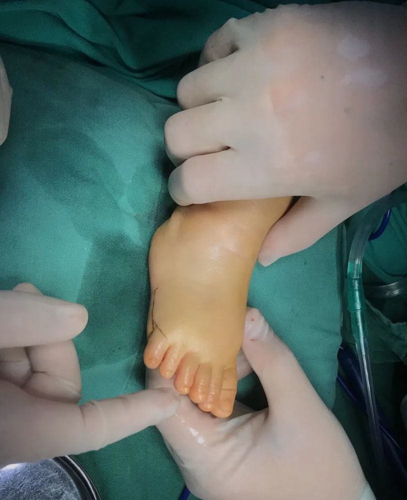 新生儿双脚各长六个脚趾一家人喜忧参半