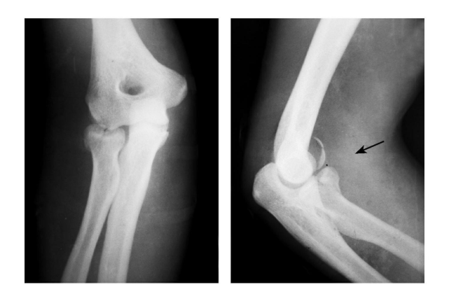 7种 肘部损伤x片详细图解 肱骨 肘关节 尺骨鹰嘴骨折