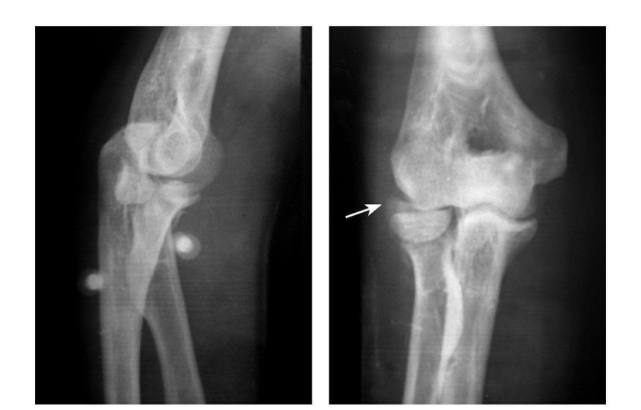 7种 肘部损伤x片详细图解 肱骨 肘关节 尺骨鹰嘴骨折
