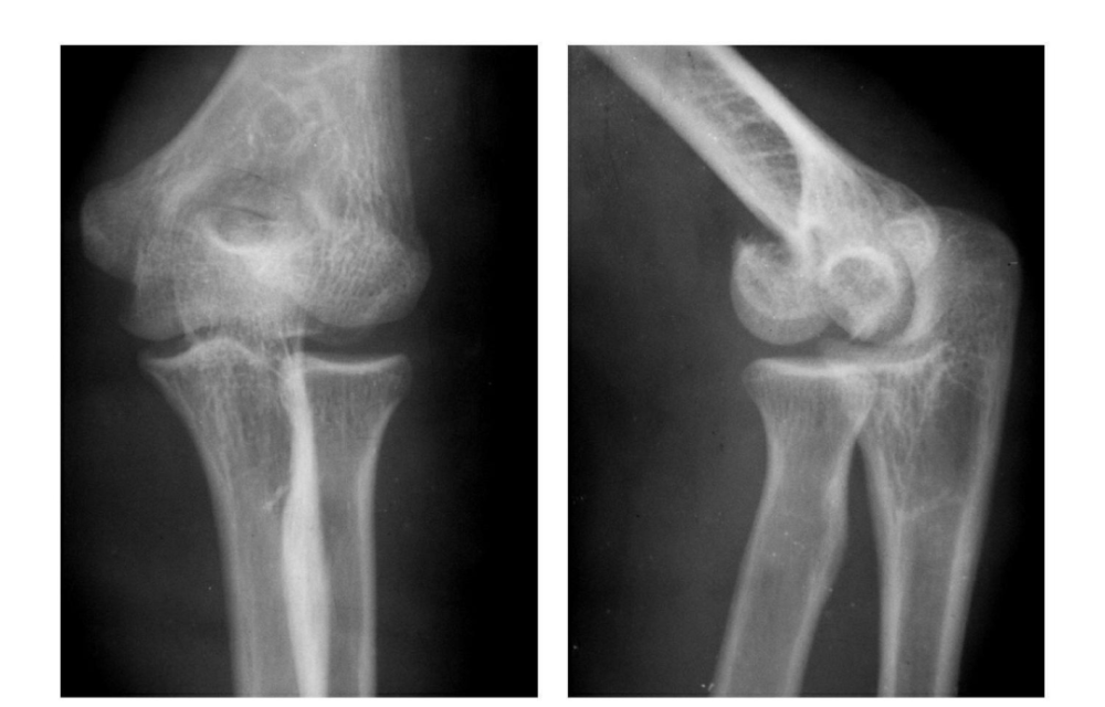 7種 肘部損傷x片詳細圖解