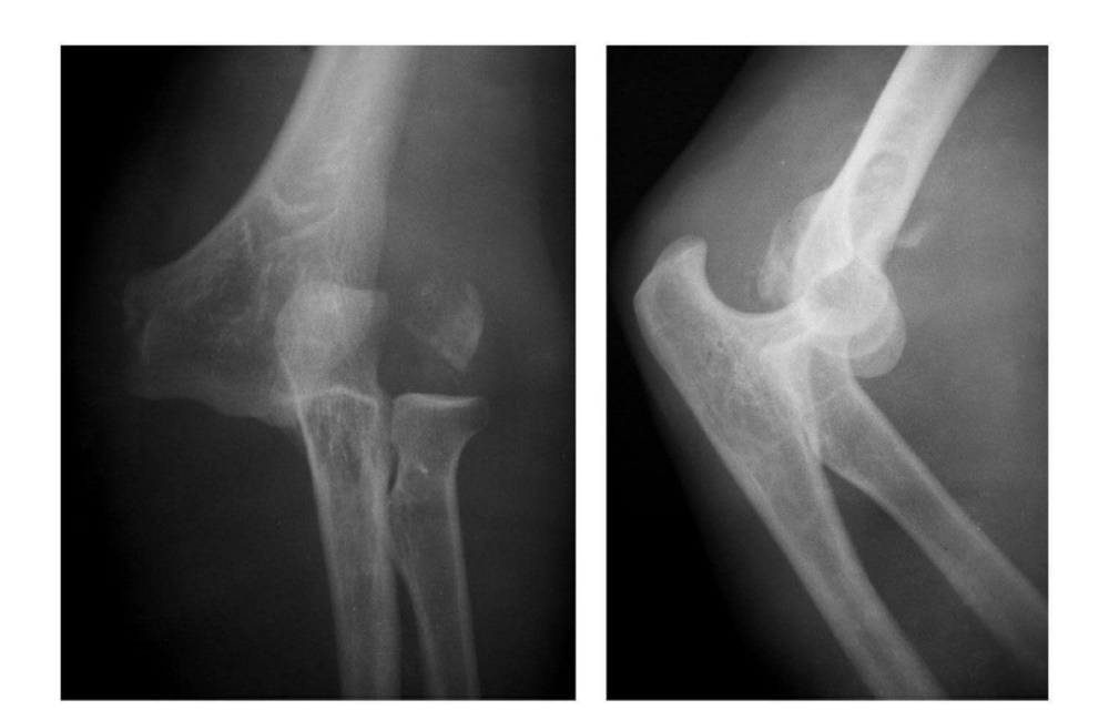 7种肘部损伤x片详细图解 腾讯新闻