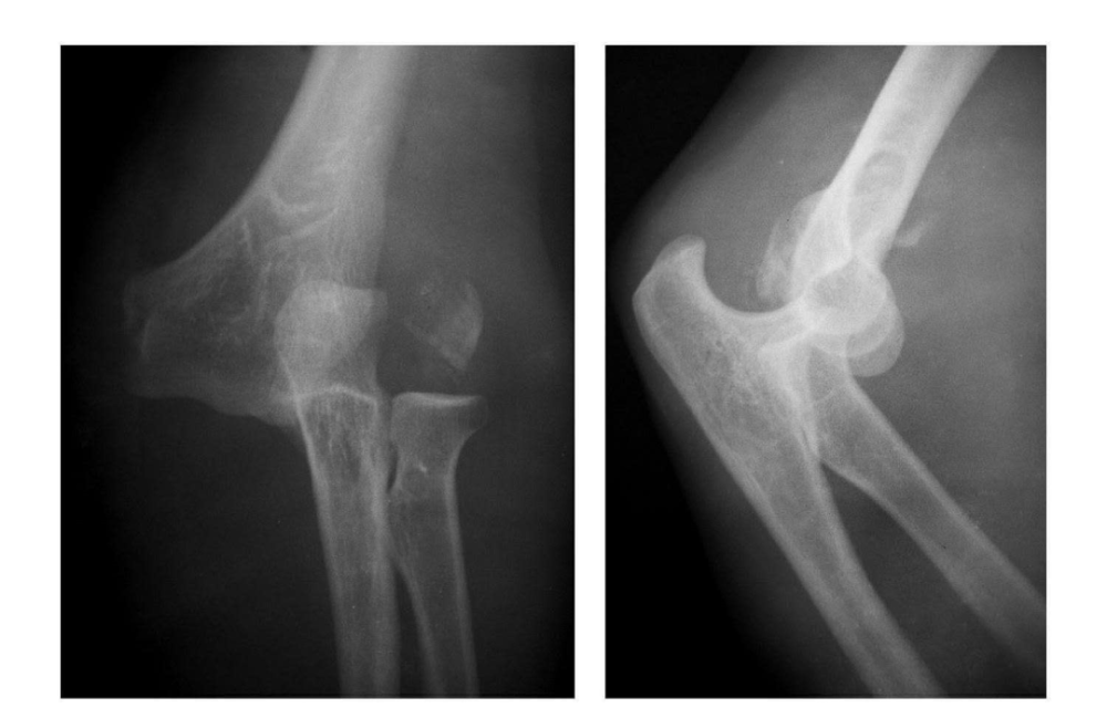 7种肘部损伤x片详细图解