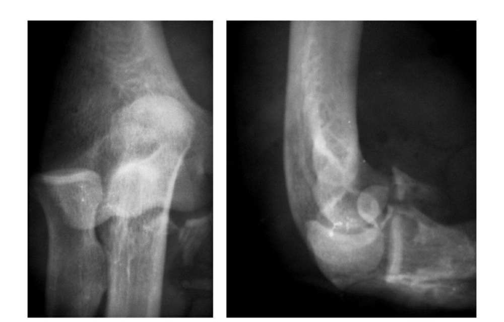 7种肘部损伤x片详细图解 腾讯新闻