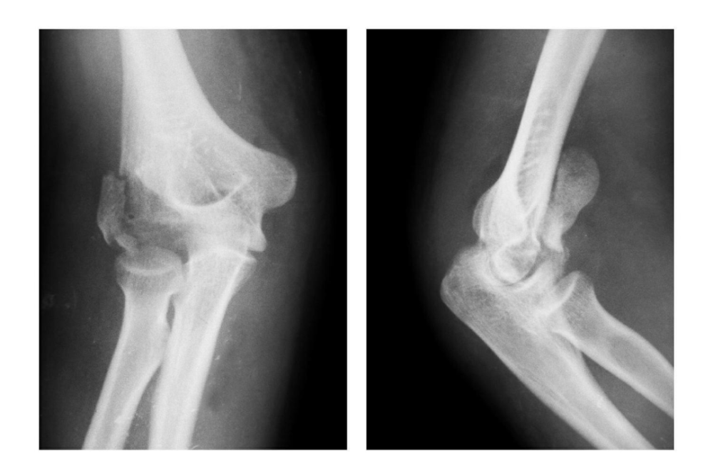 7种肘部损伤x片详细图解 腾讯新闻