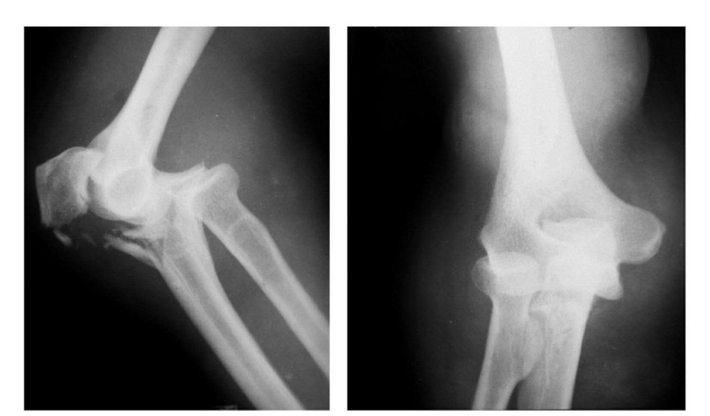 7种67肘部损伤x片详细图解