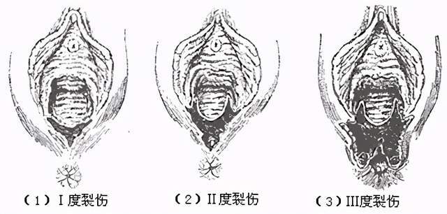什么是会阴切开?真的那么可怕吗?