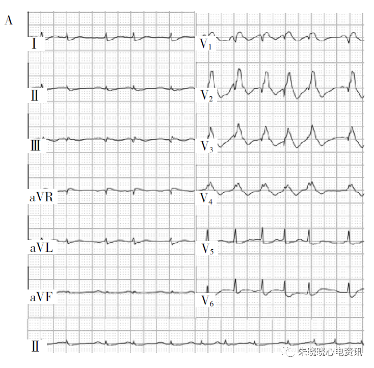 ST段改变表现的猝死预警心电图