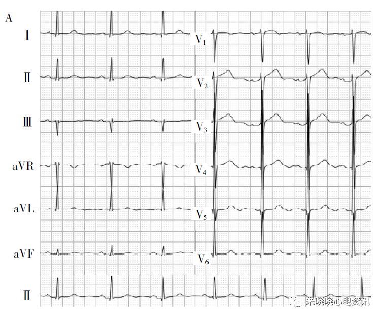 ST段改变表现的猝死预警心电图