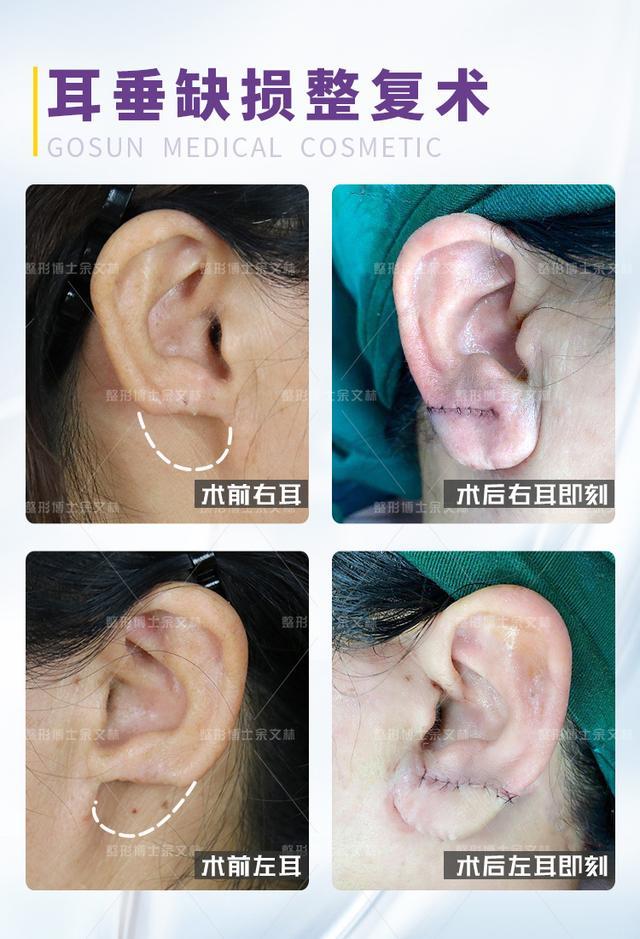 大多数情况是撕裂伤,比如耳环刮住撕扯开了耳垂,或是打架撕裂伤,或者