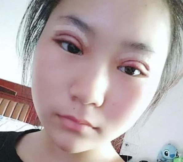 为什么不建议女生割"双眼皮"?多半有这3方面原因,庆幸没跟风!