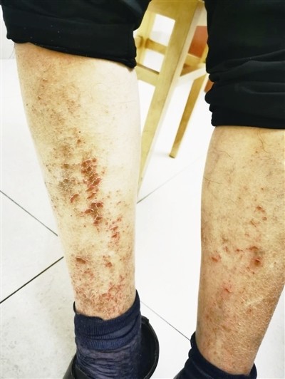 秋冬季节乏脂性湿疹进入高发期医生提醒少洗澡多喝水