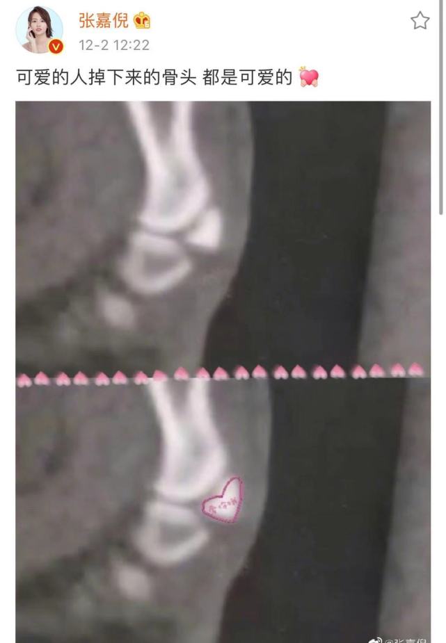 张嘉倪骨折 称 可爱的人掉下来的骨头都是可爱的 心态真好 腾讯网