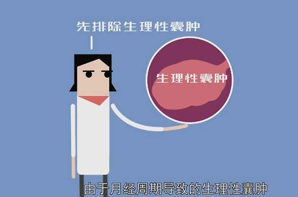 女性的生理性卵巢囊腫是怎麼回事受那些因素影響