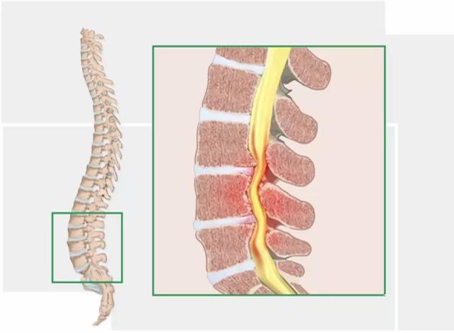 腰椎间盘突出症伴腰椎管狭窄症 怎么一下得了两种病 腰椎间盘突出症 腰椎管狭窄症 椎间盘突出症 椎管狭窄