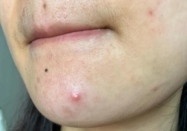 换季爆痘,逼疯了半个娱乐圈