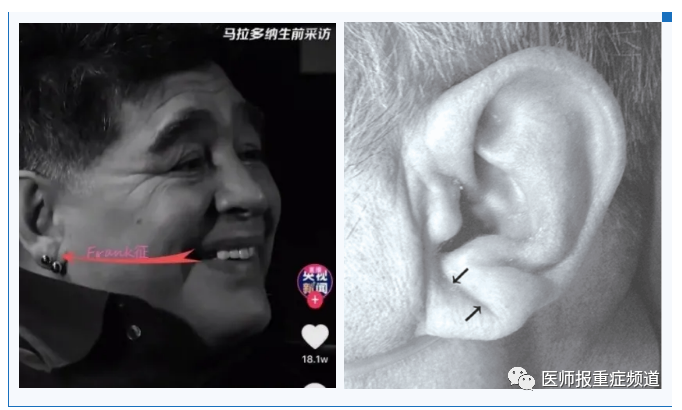 耳垂褶皱与心血管疾病有关为弄清这个问题一医学者梳