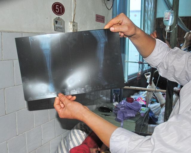 53岁阿姨散步时骨折,医生:只因一碗"断骨饭",很多人都爱吃