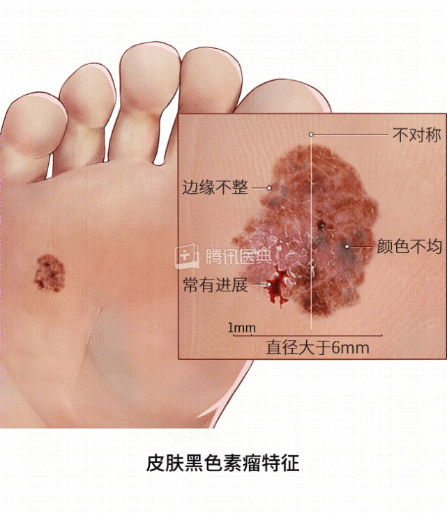 當心皮膚上這5個變化,可能是癌盯上你!