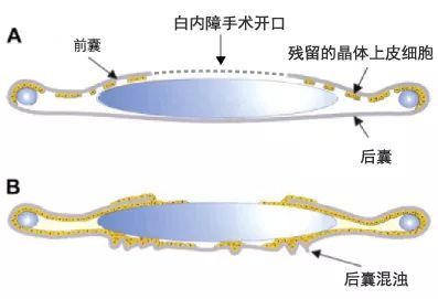 (图片来源于网络) 图a:前囊,后囊以及人工晶体位置示意图 图b:后囊