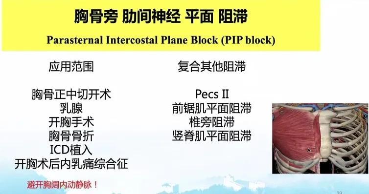 胸部手术区域阻滞方案如何选择 腾讯新闻