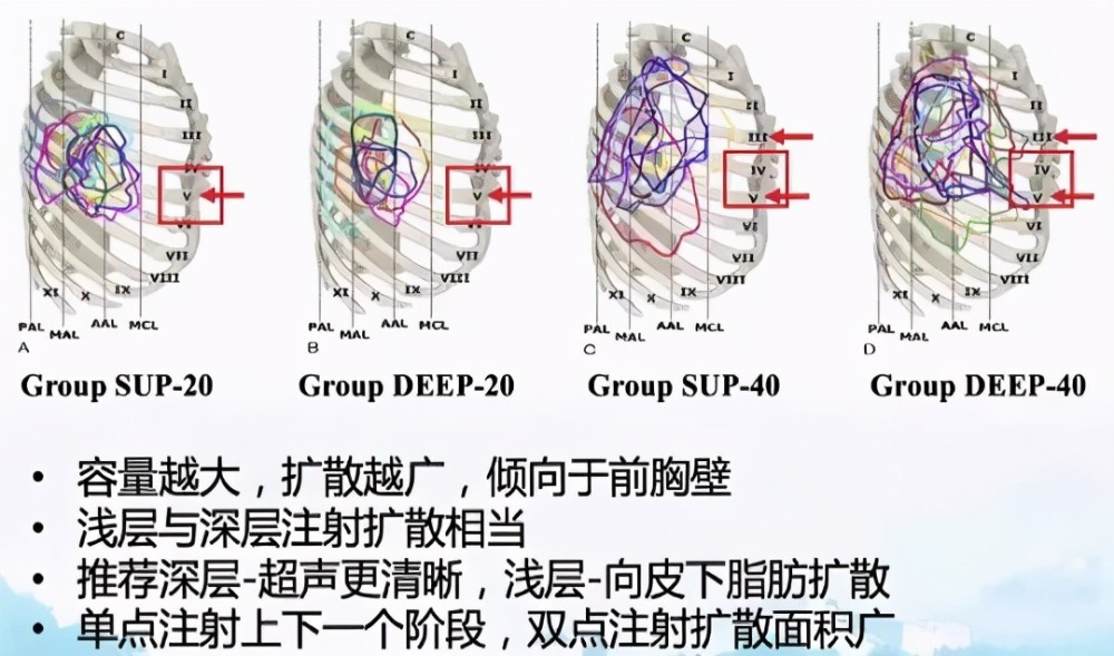 前锯肌平面阻滞浅面与深面前锯肌平面阻滞是一种最近提出的新的胸部