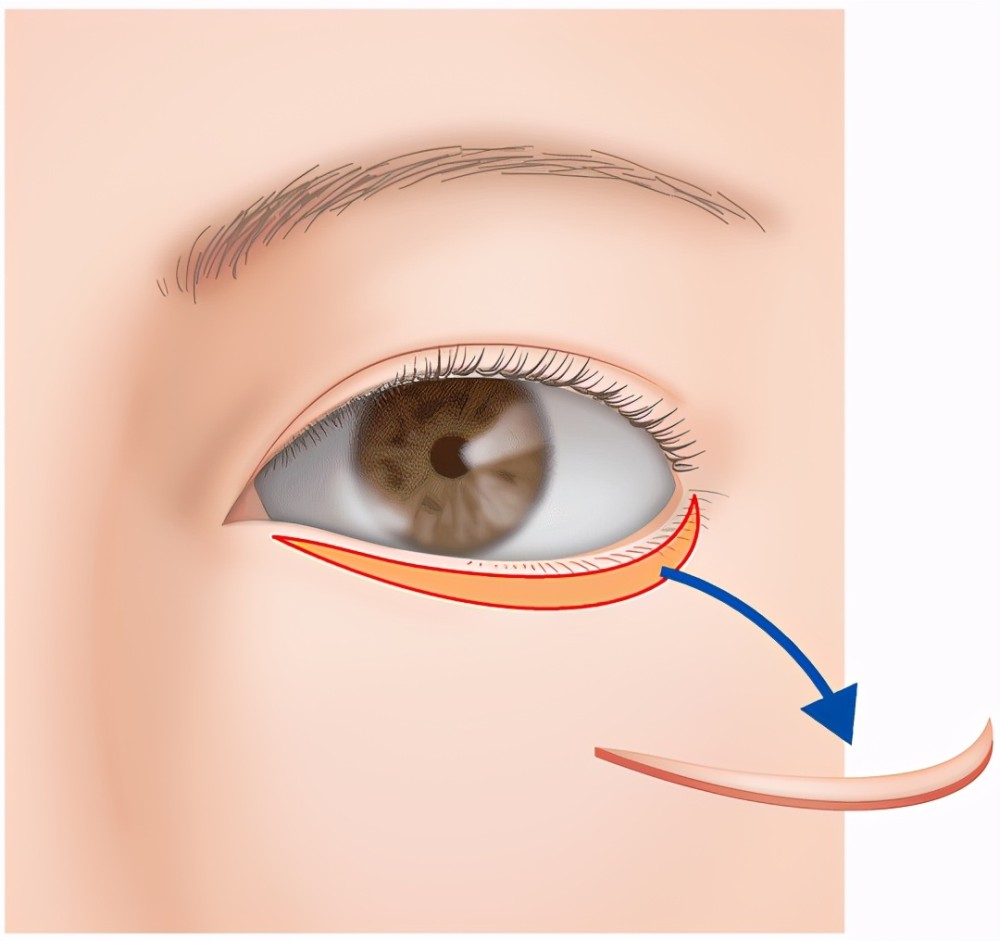 杭州眼部整形|變美小心機——眼瞼下至_騰訊新聞