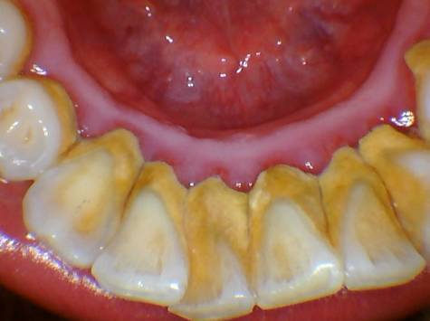 牙垢和牙石的区别