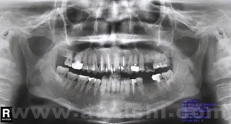 看牙为什么要拍全景片?_腾讯新闻