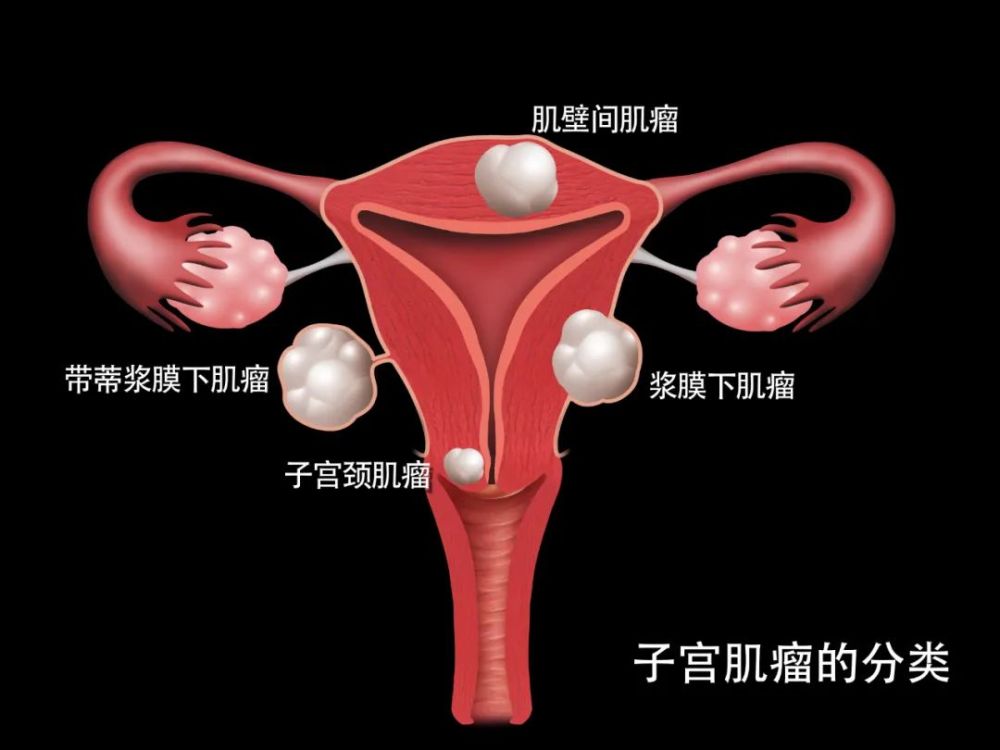 一例找不到肌瘤的 肌瘤剔除术 腾讯新闻