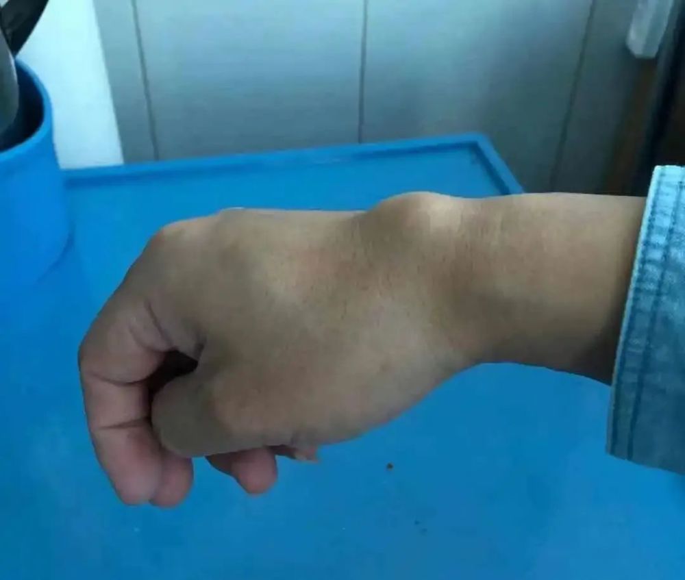 手腕疼还鼓个包当心得了腱鞘囊肿这套护手操送给你