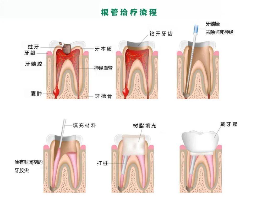 2分鐘讀懂什麼是牙醫口中的根管治療