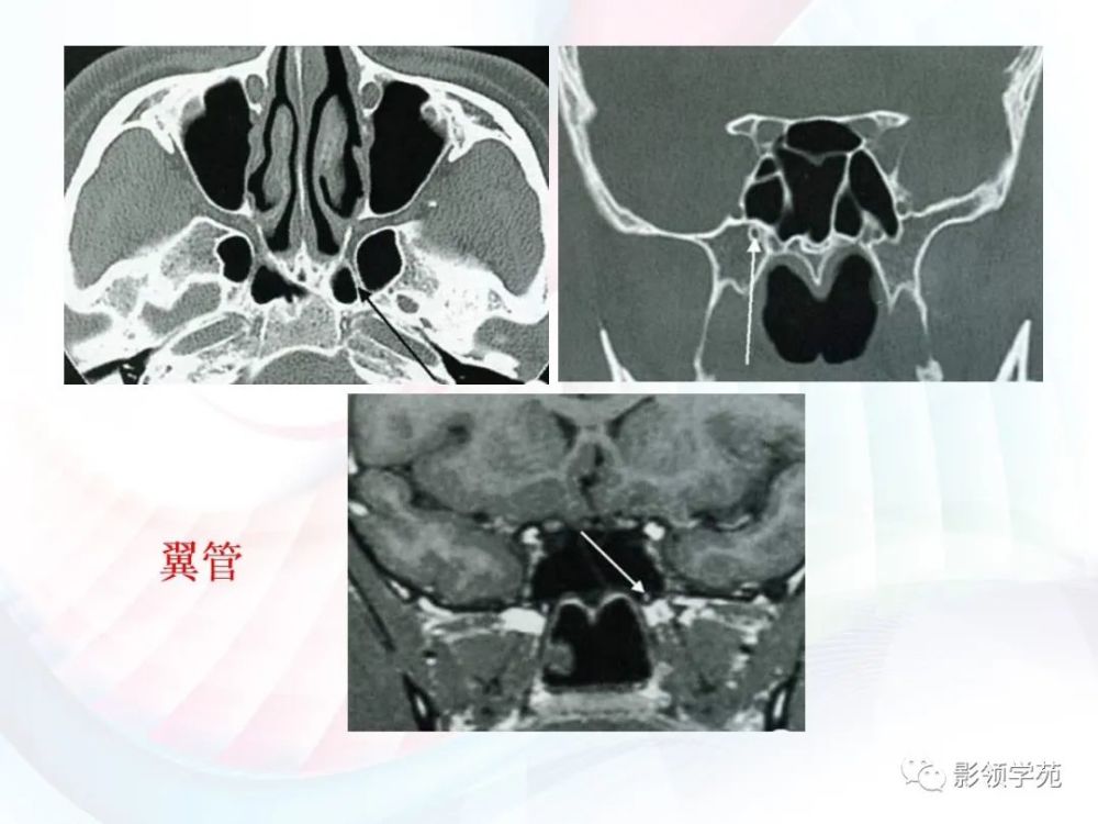 眶上裂,圆孔,卵圆孔,棘孔,破裂孔等后界是颞骨岩部前界是蝶骨大翼