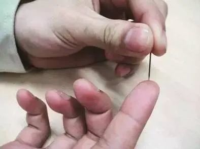 i导读:急性化脓性扁桃体炎,咽炎之放血新技能,你get到了没 !