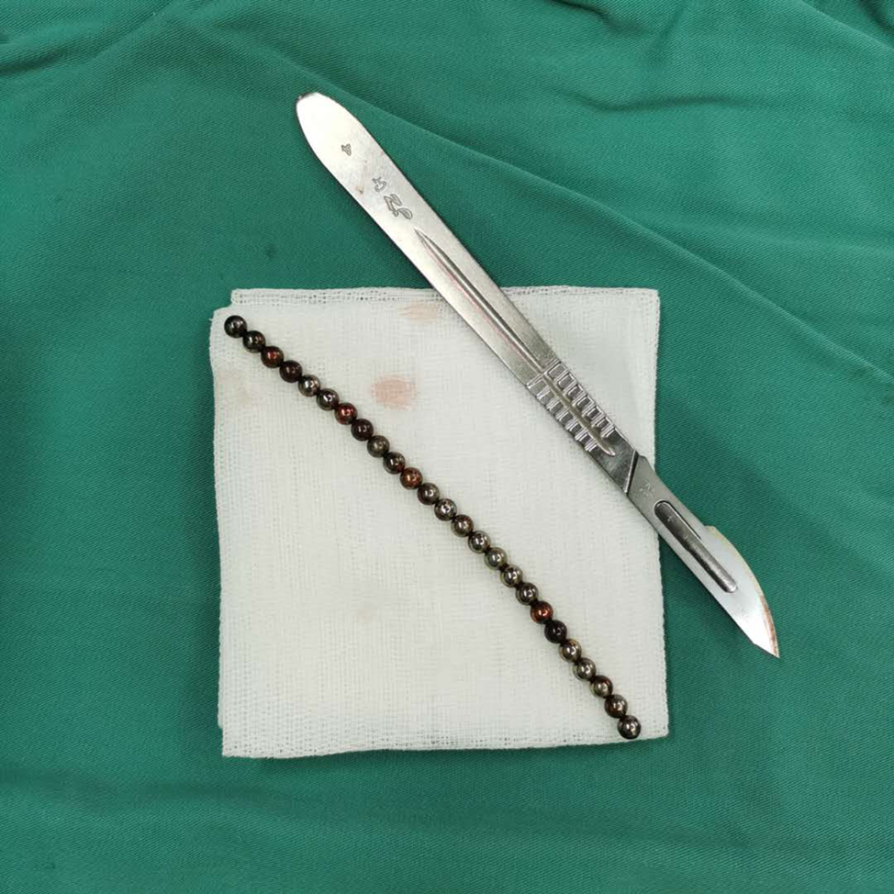 一串"膀胱珍珠"的故事丨67延安市人民医院泌尿外科抢救记_腾讯新闻