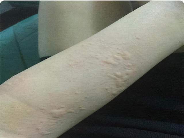 了某种化学物质或者吃了某种食物或服了某种药后,出现的光敏性皮肤病