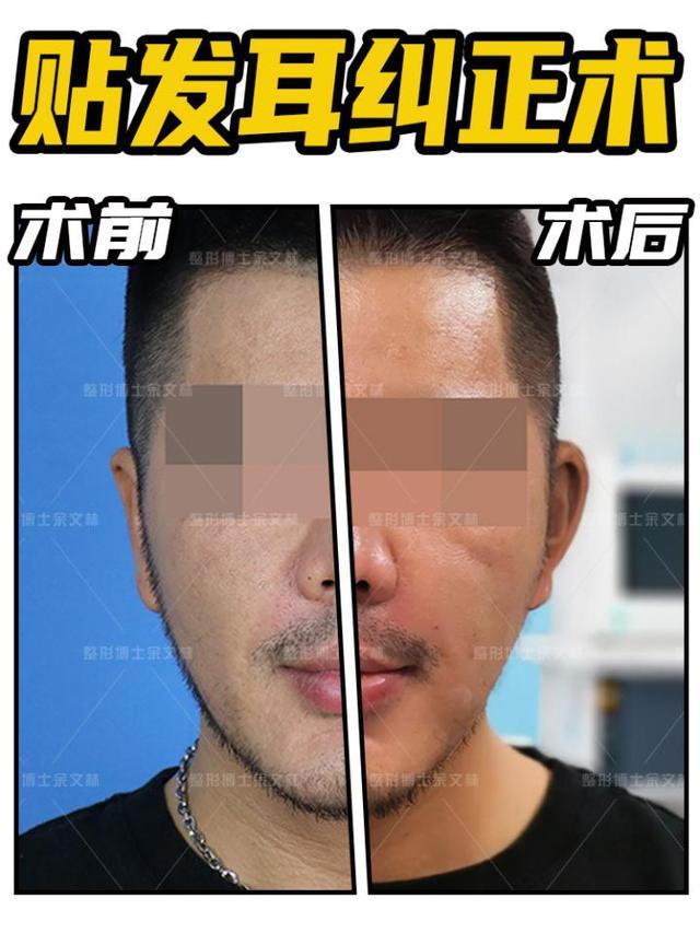 男性贴发耳纠正 小小变化大不同 腾讯网