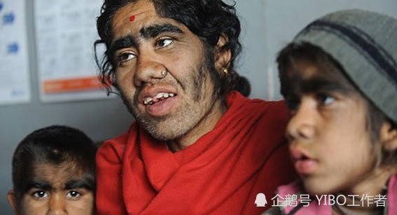 西班牙20小孩误喝生发水全身长毛发变狼孩