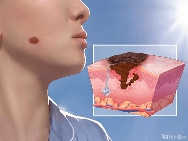 别小看脸上的一颗痣 有这4种形态的 很可能是皮肤癌 皮肤癌 黑色素瘤 结痂